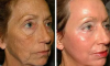 2 enkla sätt att ta bort rynkor i ansiktet hemma utan kirurgi och utan kosmetolog