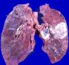 Lungcancer: hur man inte ska missa starten av sjukdomen?