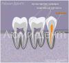 Hur man hittar och behandlar tandkanaler i Lumident