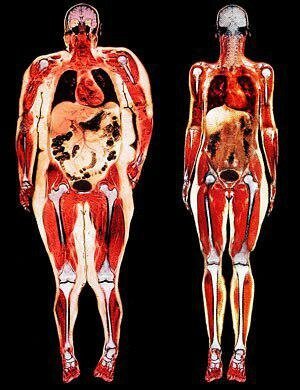 Vänster - bara visceral fetma. Alla organ kvävd med fett.