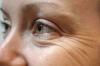 Hur kan man förhindra uppkomsten av rynkor runt ögonen