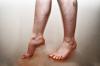 Kränkning av blodflödet i benen: orsaker, symptom