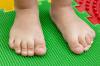 "Bra" och "onda" former av platta fötter hos barn