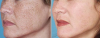 Den bästa lösningen för pigmentering i ansiktet, hals och dekolletage. Effekten märks omedelbart efter den 1: a användning
