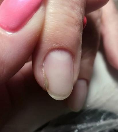 Här är vad konsekvenserna blir om dina egna naglar zauzhat, bärande punkt inväxt
