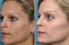 Huden på ansikte och händer, utan pigmentering och rynkor för 5 rubel: Resultatet för en dags användning