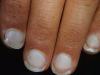 Varför bleka naglar