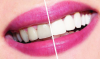 Hur att bleka tänderna hemma? dental råd.