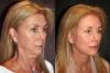 Hur är vanliga kvinnor 50-70 år som har gjort en ansiktslyftning