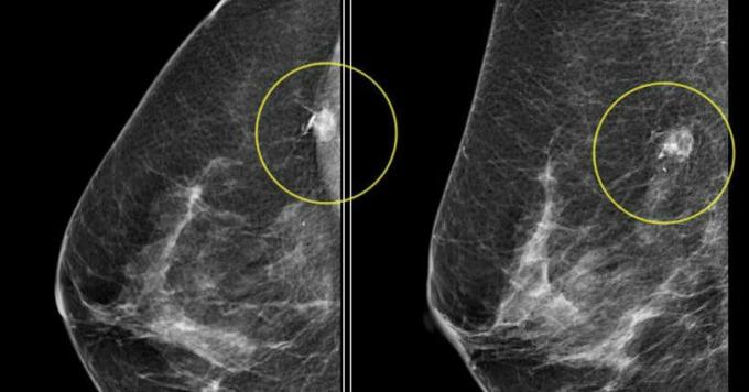 bröstcancer - bröstcancer