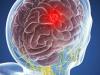Hjärntumör: 5 symptom som inte kan ignoreras