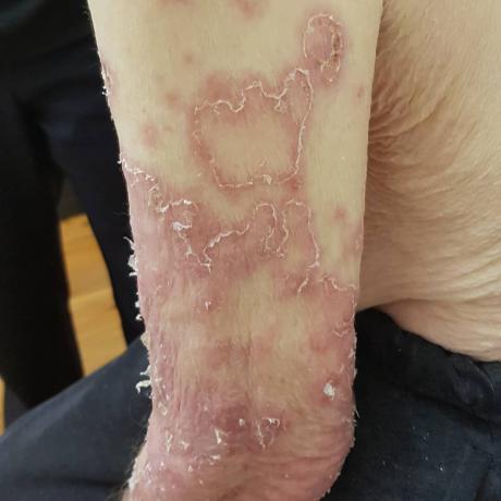 Här är pellagra. Bilder av patienten från den amerikanska vårdhem