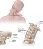 4 grundläggande övningar för halsryggen kommer att bidra till att glömma smärtan och osteokondros!
