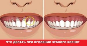 Hur man behandlar tandköttet när tänderna blir bare halsen?