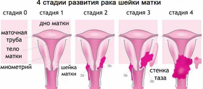 4 stadier av livmoderhalscancer