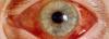 Den akuta glaukom: vad det är, hur man behandlar?