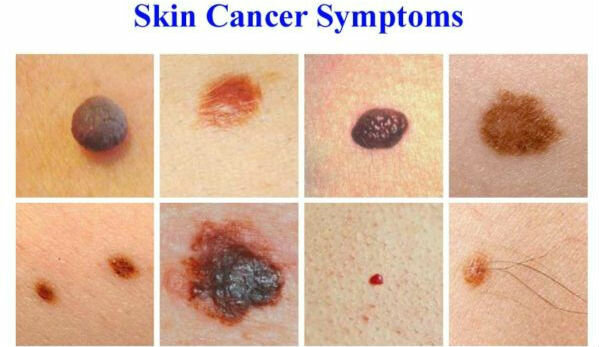 Symtom av hudcancer