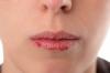 5 tips om hur man kan förebygga chapping av läppar